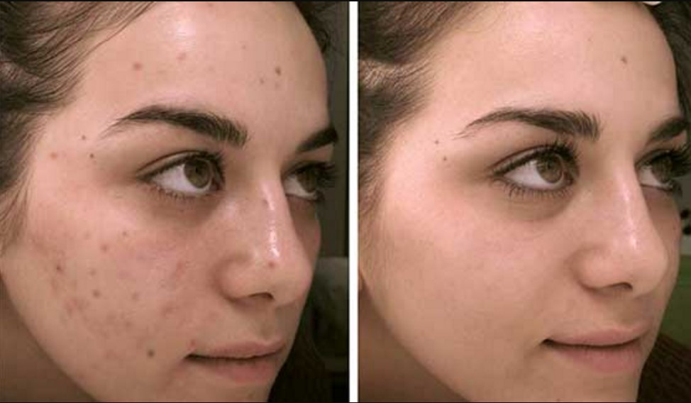 remove pimples and dark spots from face naturally